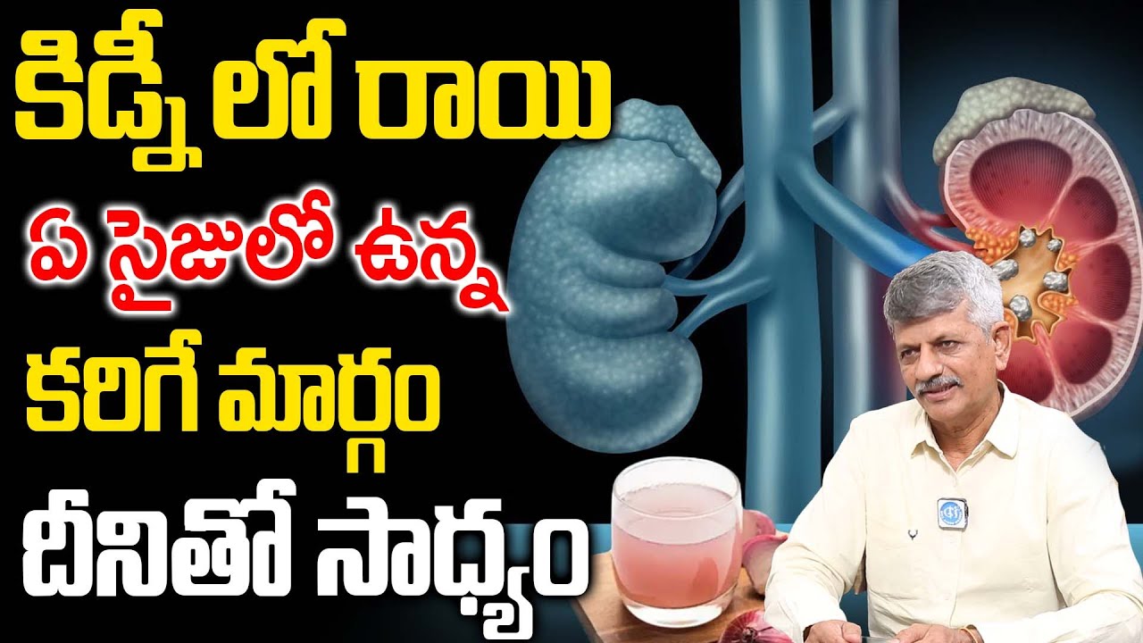 గొంతులో పడగానే కిడ్నీలో 11MM సైజు రాయిని కూడా పిండి పిండి చేస్తుంది Kidney Stones | Dr Anjaneya Raju