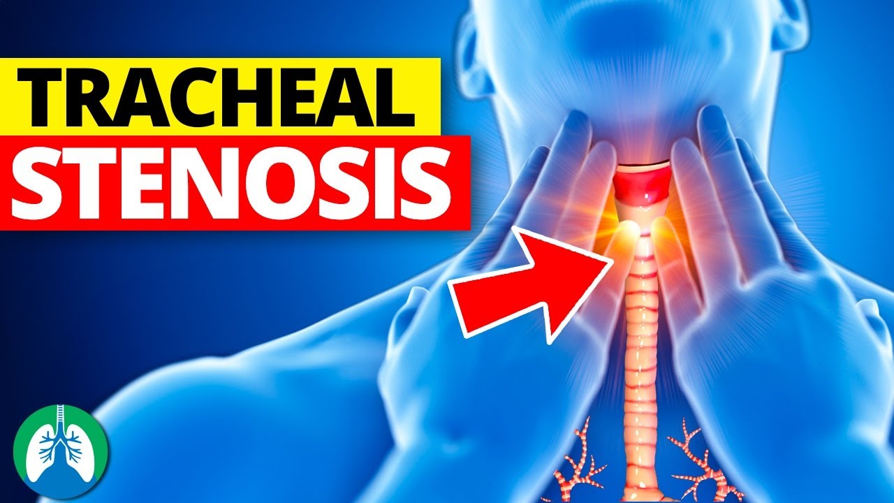 Tracheal Stenosis (Medical Definition) | Quick Explainer Video