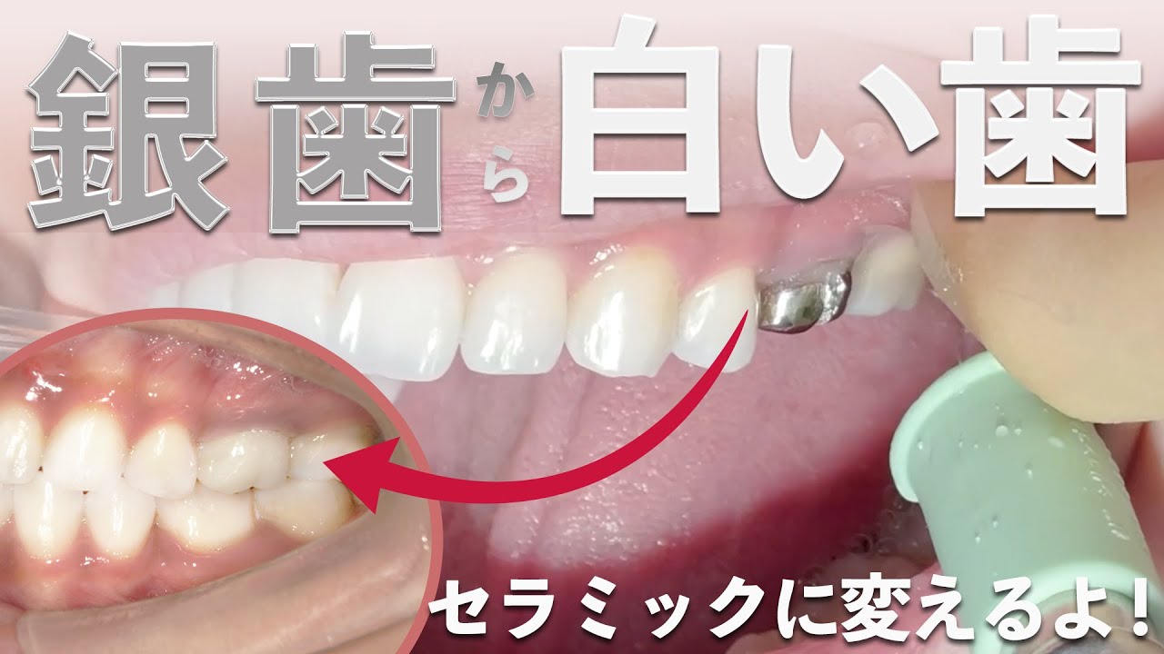 【印象激変】銀歯からセラミックへ【矯正後の治療】