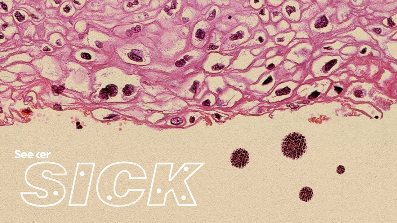 This Is How HPV Causes Cancer