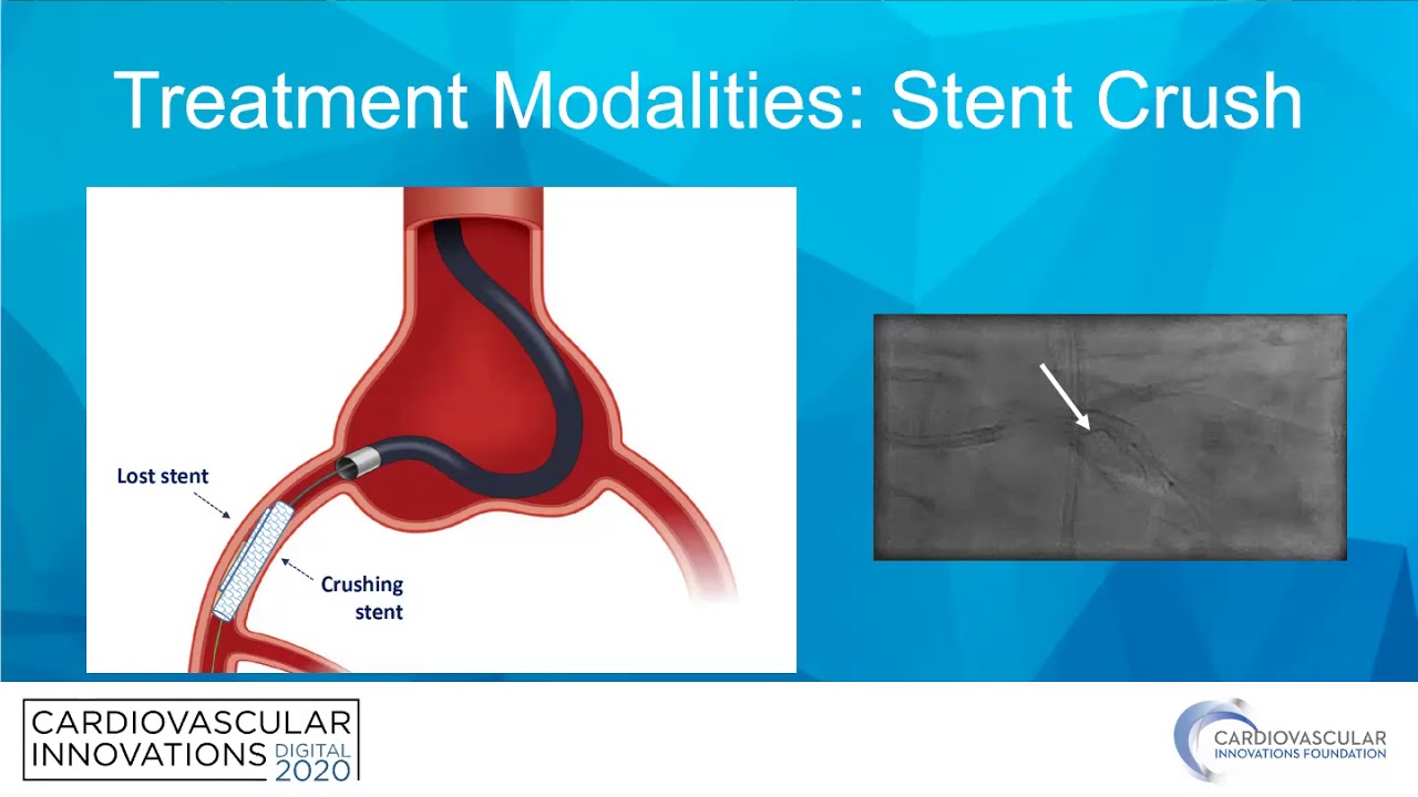 Stent loss algorithm-Robert Riley, MD