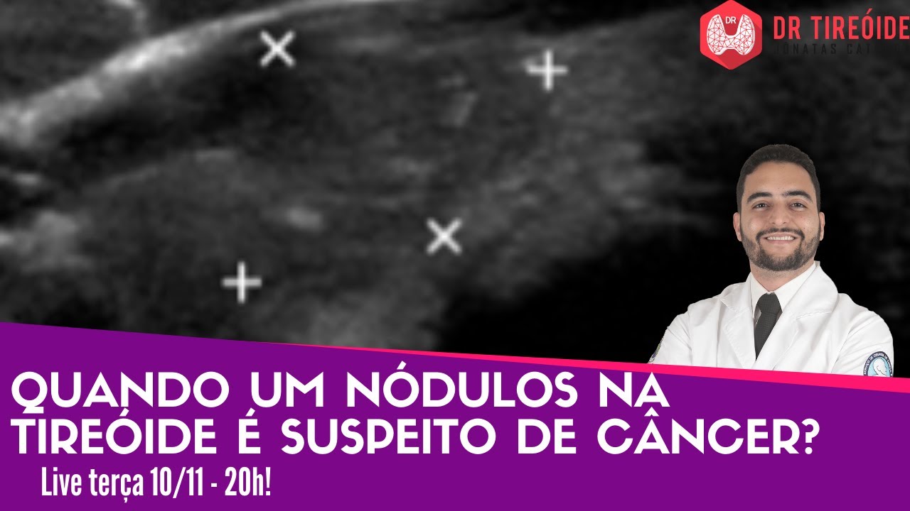 Quando um nódulo na tireóide é suspeito de câncer?  Dr Tireóide responde #112#