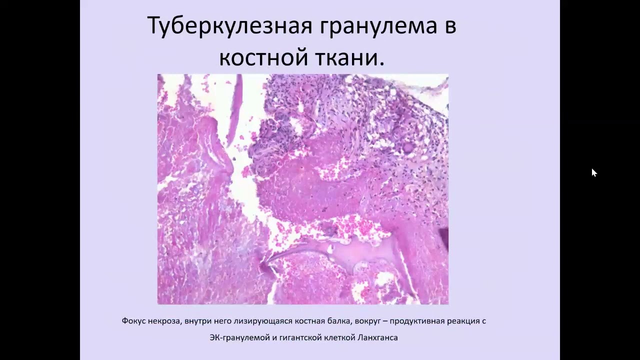 Основные характеристики внелегочных локализаций туберкулеза. Костно-суставной туберкулез.