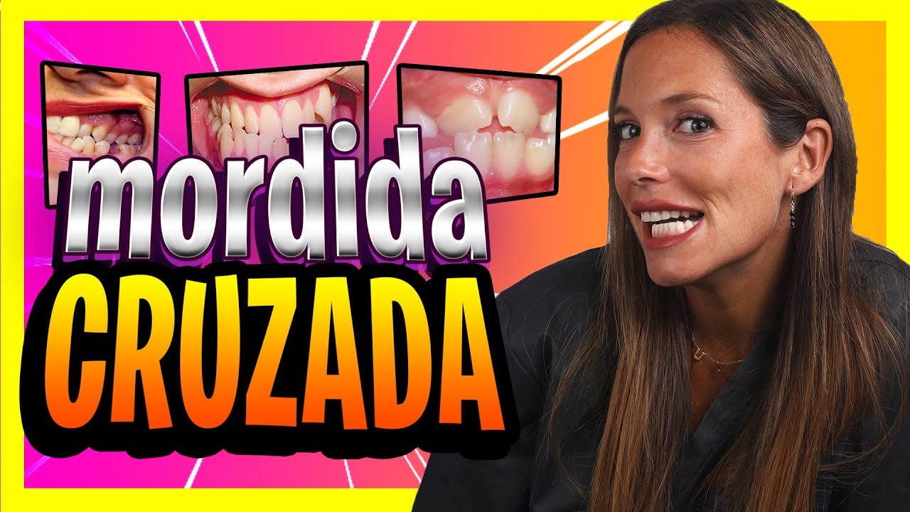 👉Que es la 𝙈𝙊𝙍𝘿𝙄𝘿𝘼 𝘾𝙍𝙐𝙕𝘼𝘿𝘼 𝙋𝙊𝙎𝙏𝙀𝙍𝙄𝙊𝙍📍Como Corregir Mordida INVERTIDA UNILATERAL Y BILATERAL