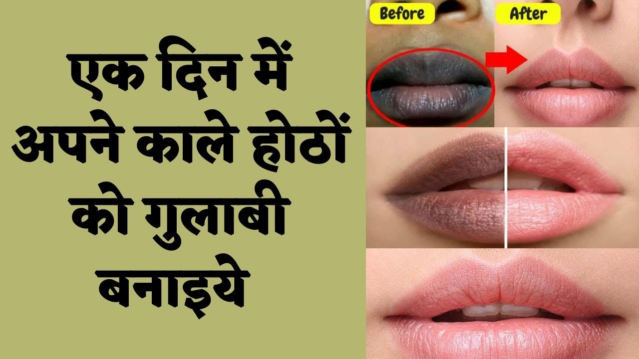 HOW TO GET PINK LIPS NATURALLY? गुलाबी होठों के लिए के लिए क्या करें ? by Dr. Manoj Das