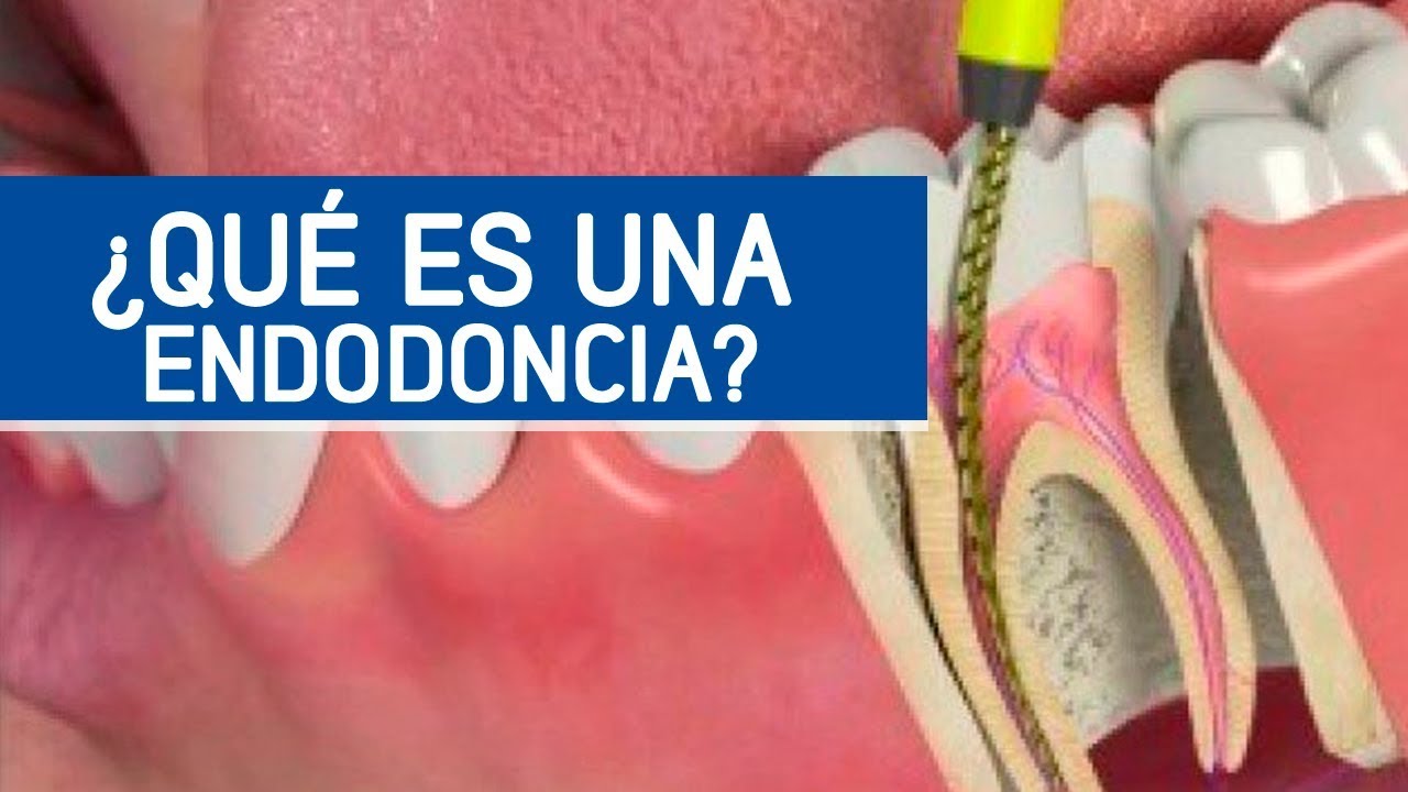 Cómo es una endodoncia, matar el nervio dental / Odontoespecialistas
