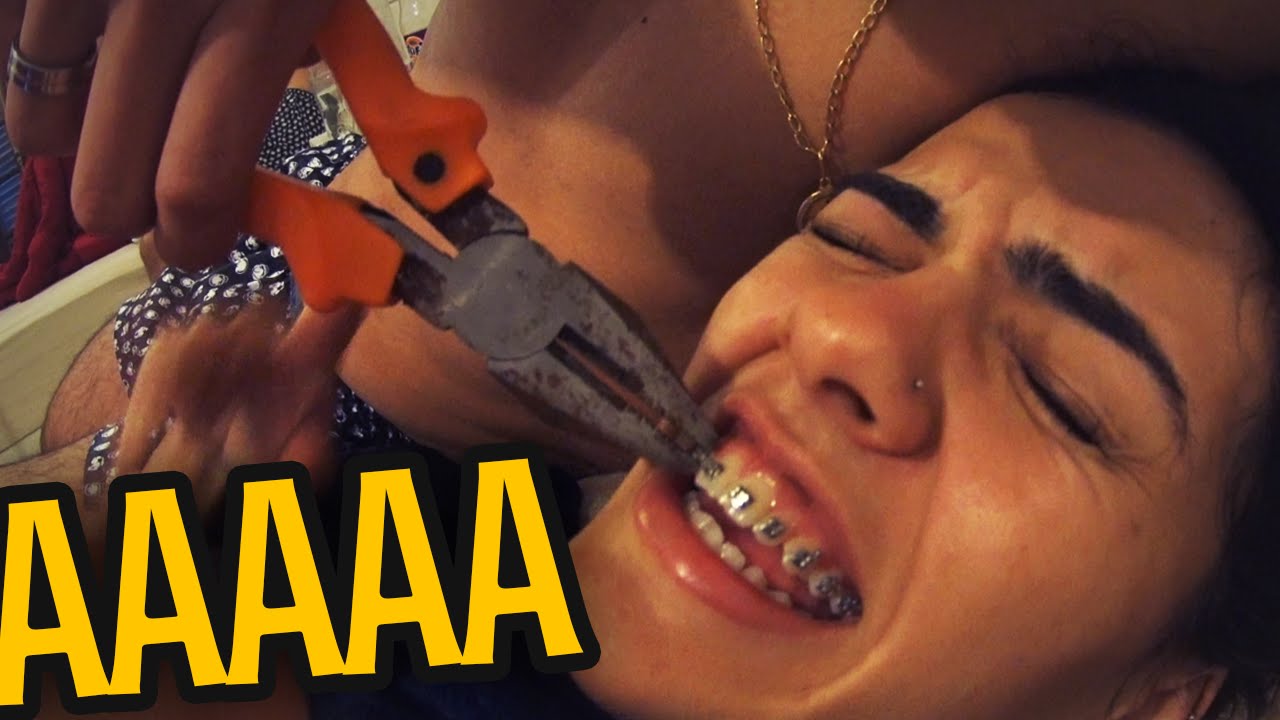 QUASE QUEBRA O DENTE TIRANDO O APARELHO COM ALICATE!