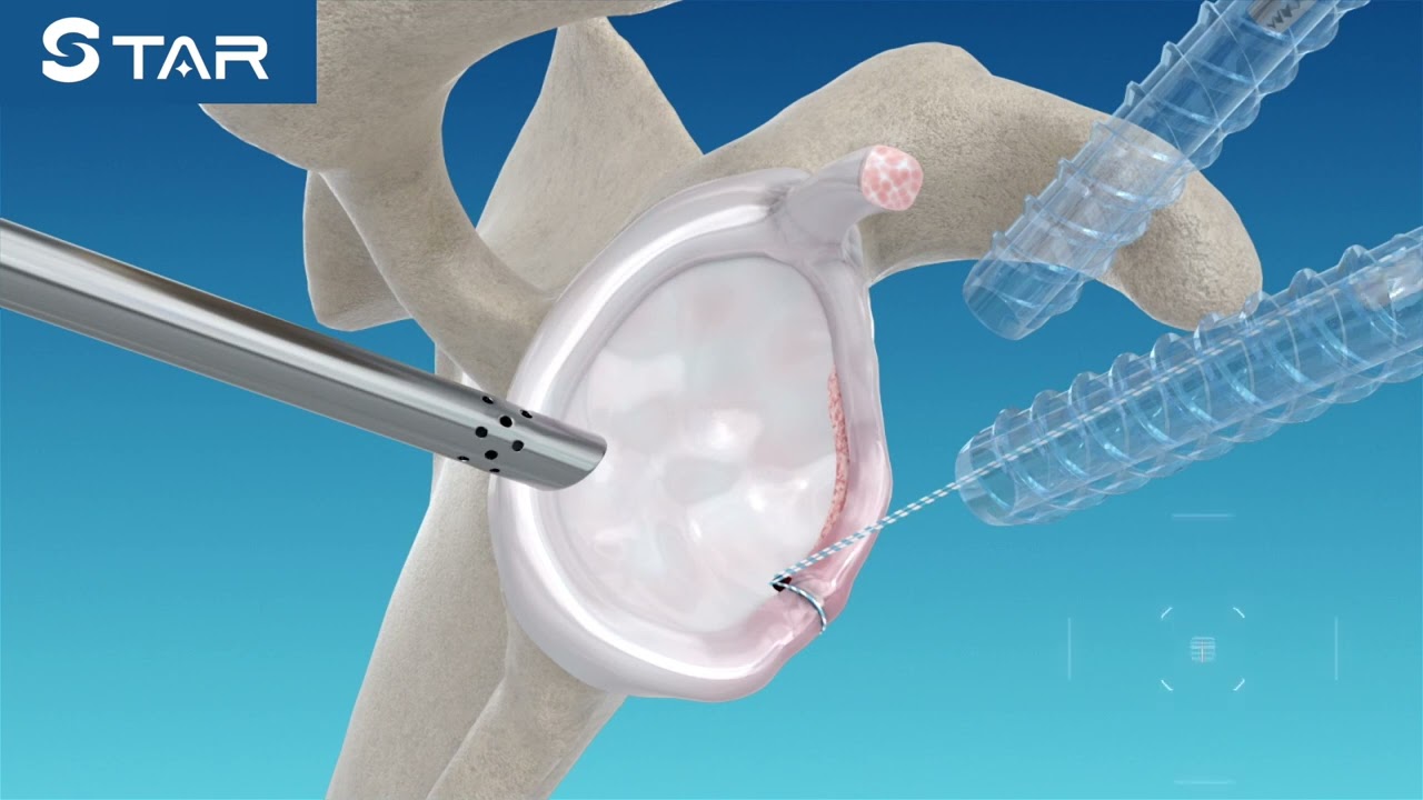 Labrum Repair (Shoulder Instability) - STAR Sports Medicine