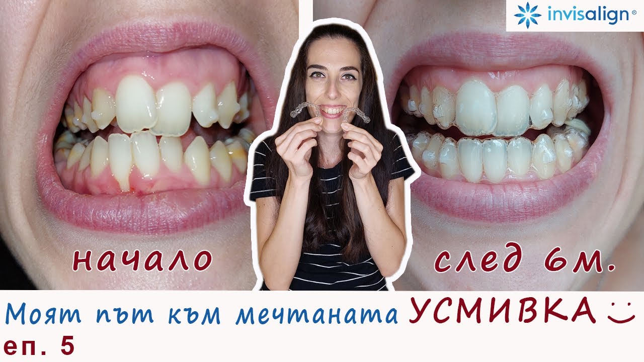 6 месеца с алайнерите на Invisalign еп. 5 - резултати и съвети от личен опит