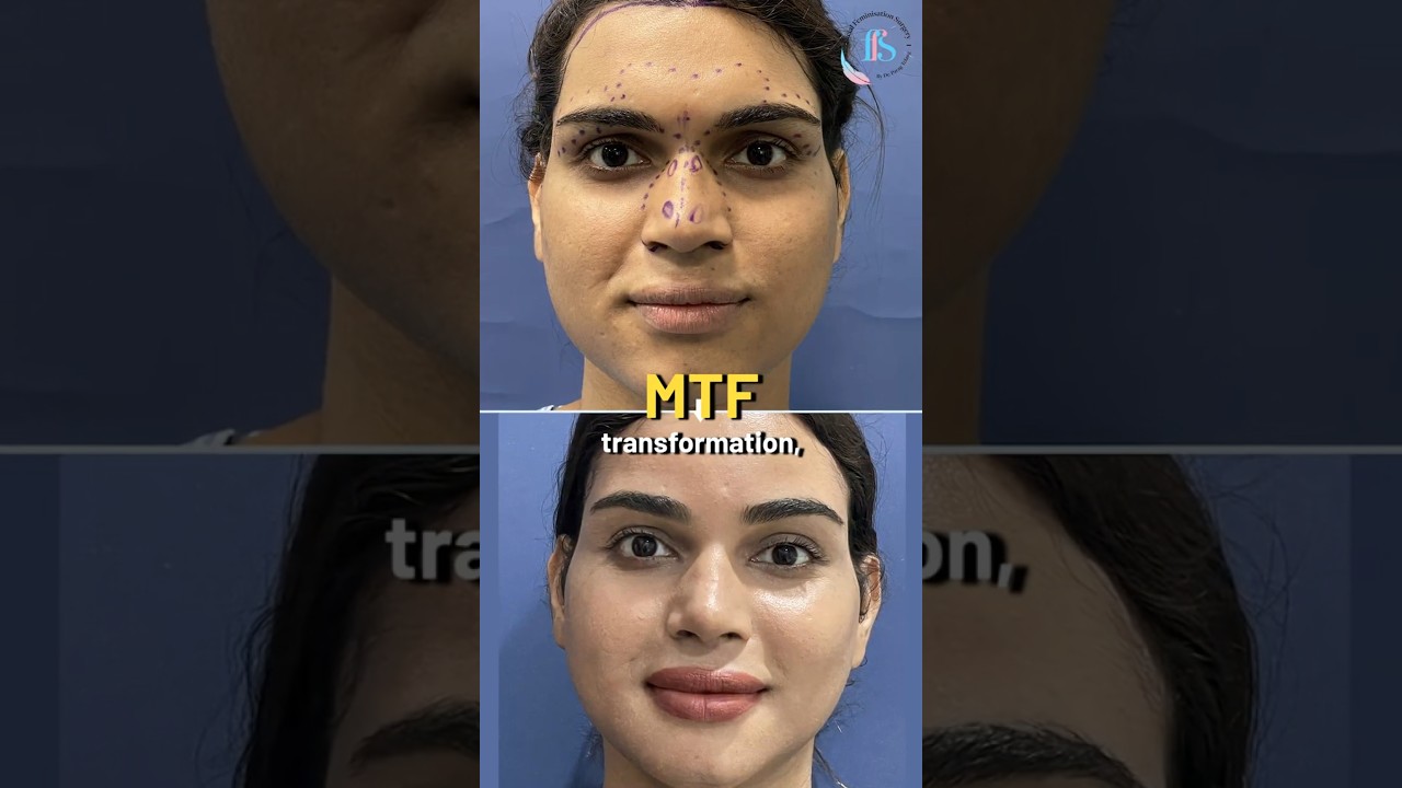 MTF Gender Transformation: How Long Does the Journey Take? #drparagtelang #shorts