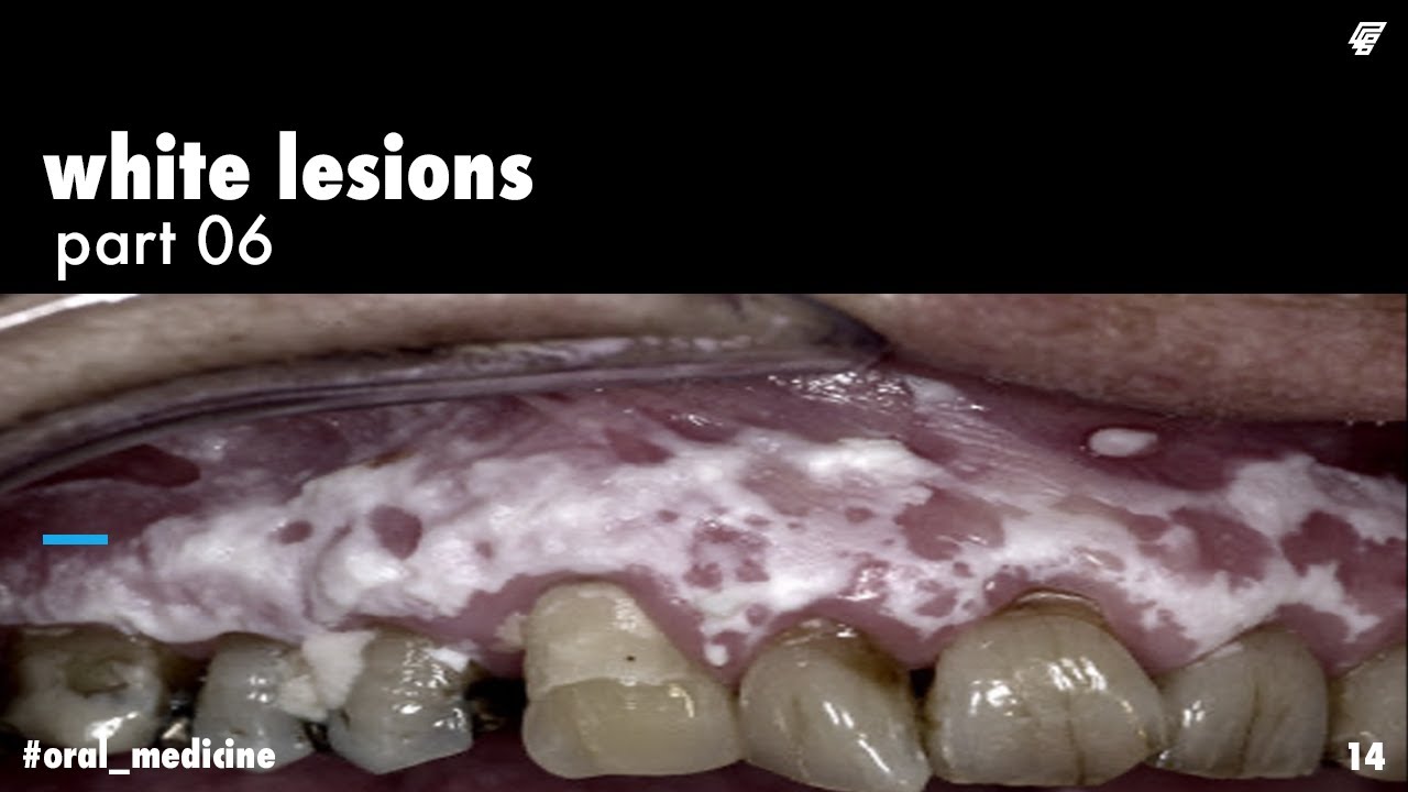 white lesions || lichen planus 1 || oral medicine _ عزت شومان
