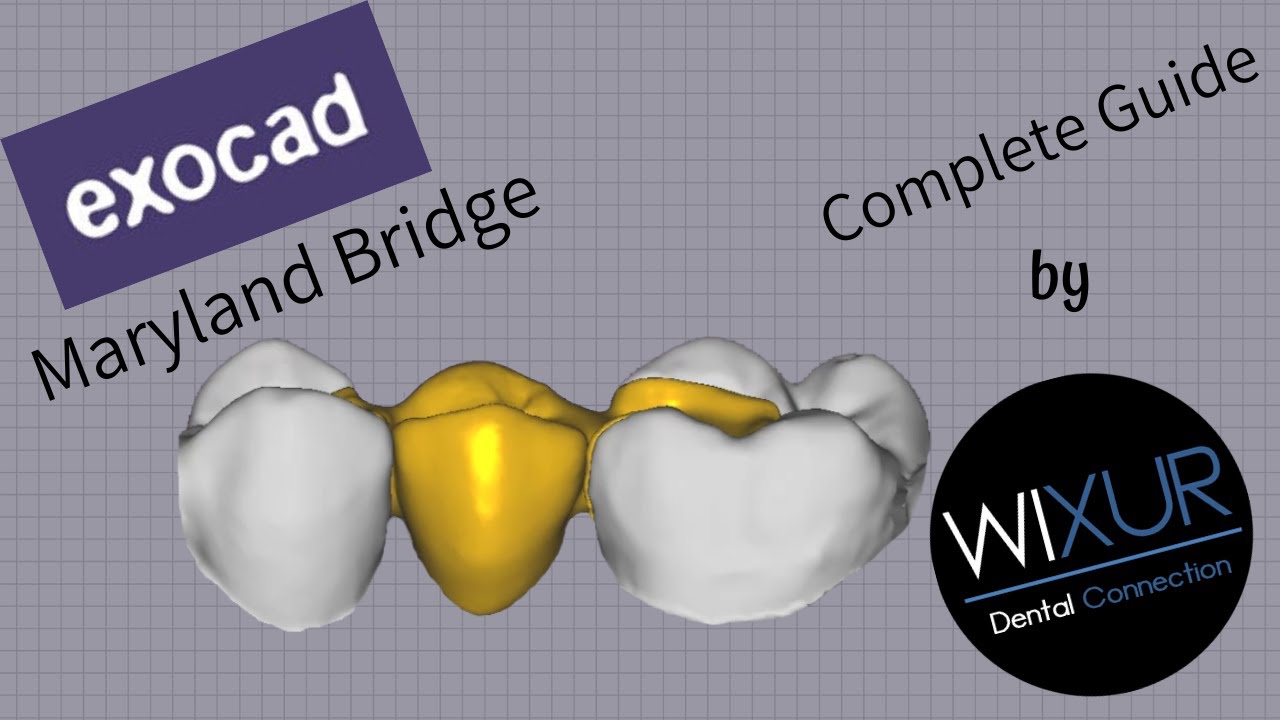 Exocad - Maryland Bridge (metal-free)