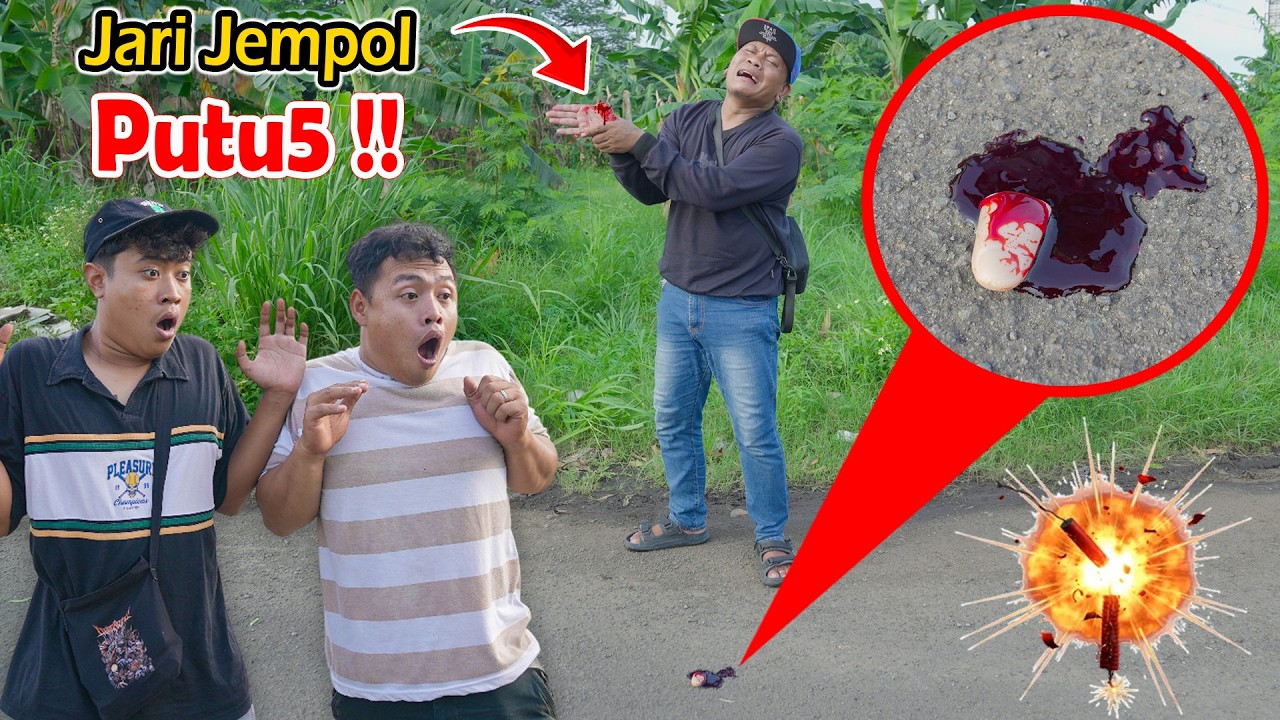GAWAT !! Jempol Jari Timbul Putu5 Karena Kena Petasan