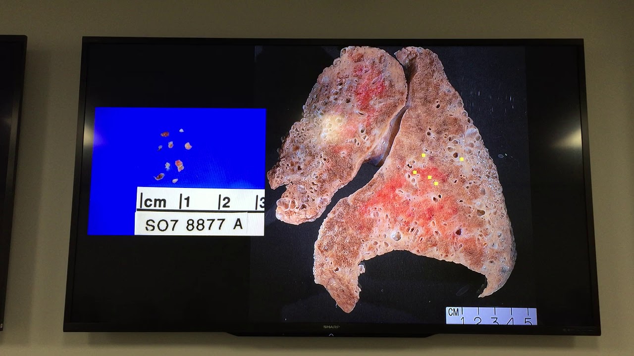 Introduction to Lung Pathology