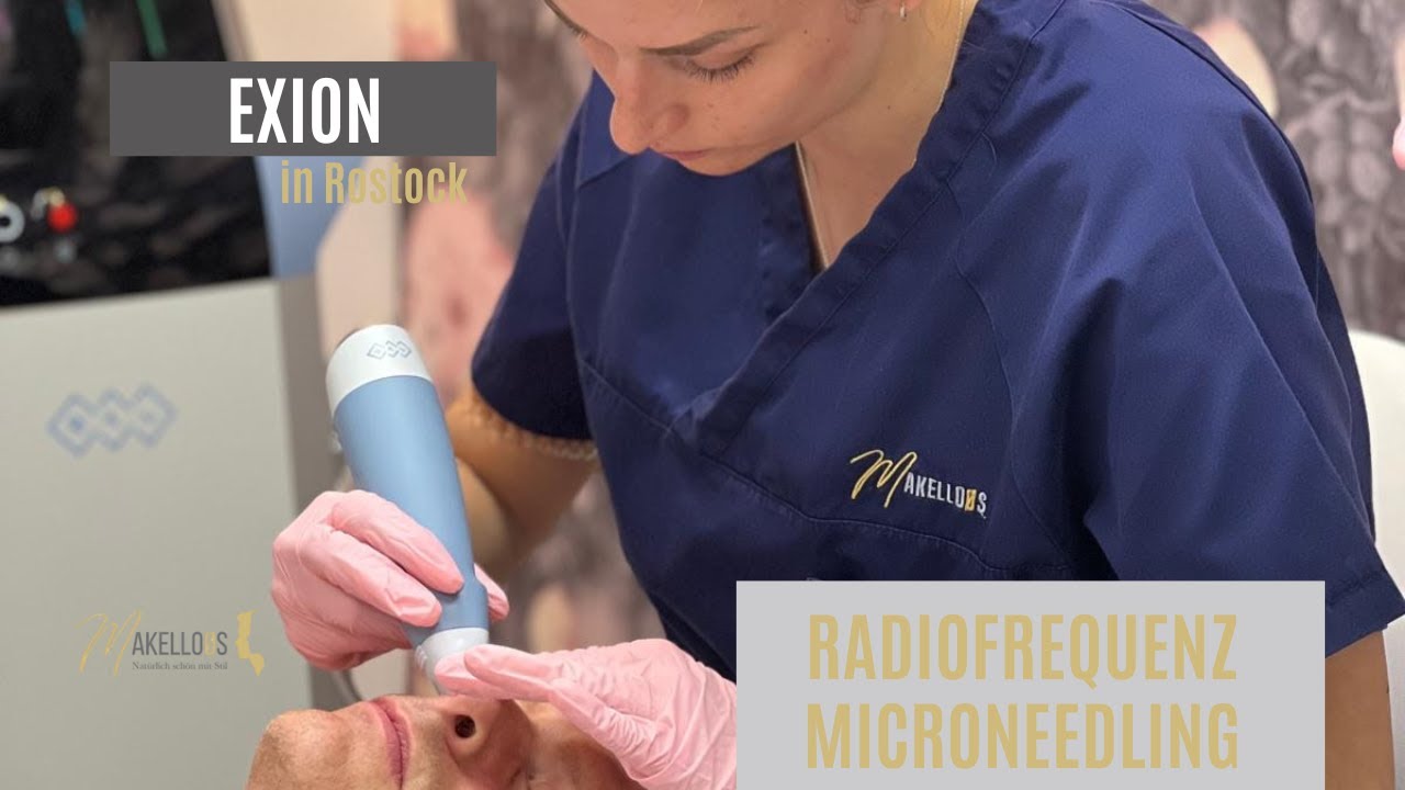 EXION Radiofrequenz Microneedling bei Hängebäckchen - Hautstraffung - Makelloos Rostock Dr Teichert