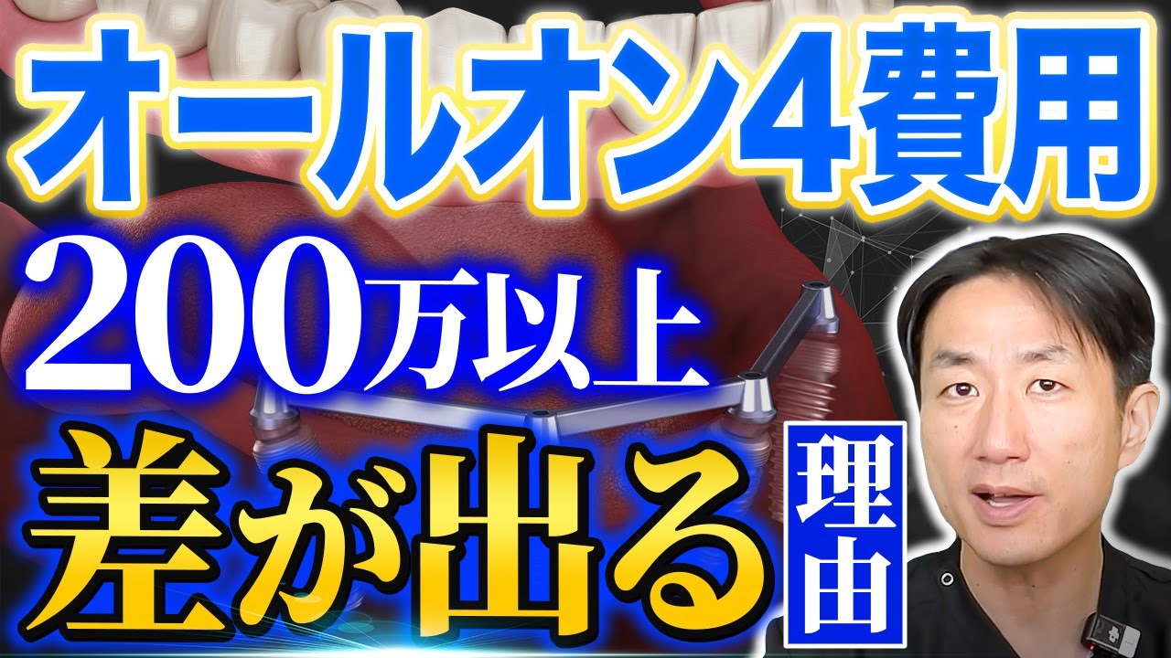 【オールオン4】インプラント費用の決め方を特別公開