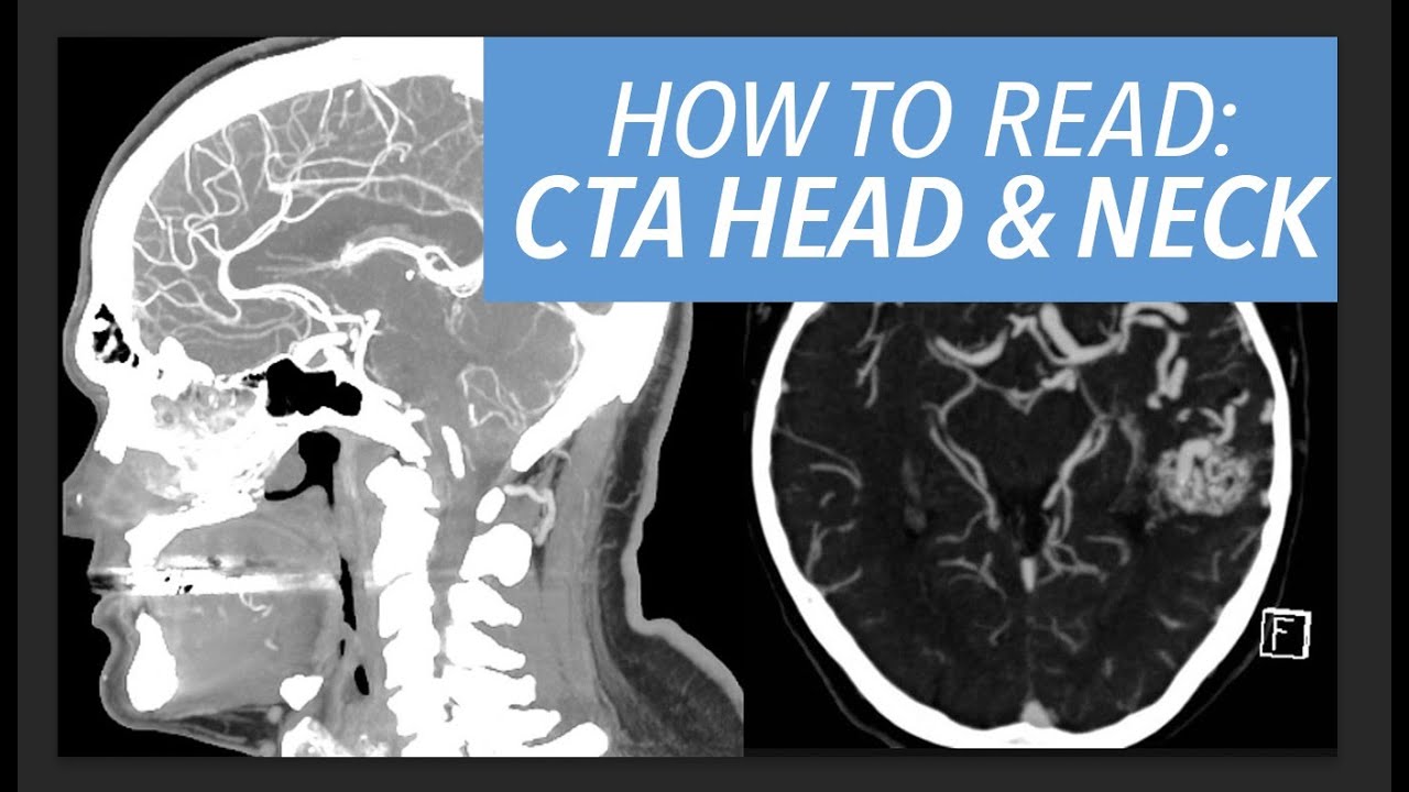 How to Read a CTA of the Head & Neck: An Approach for Beginners