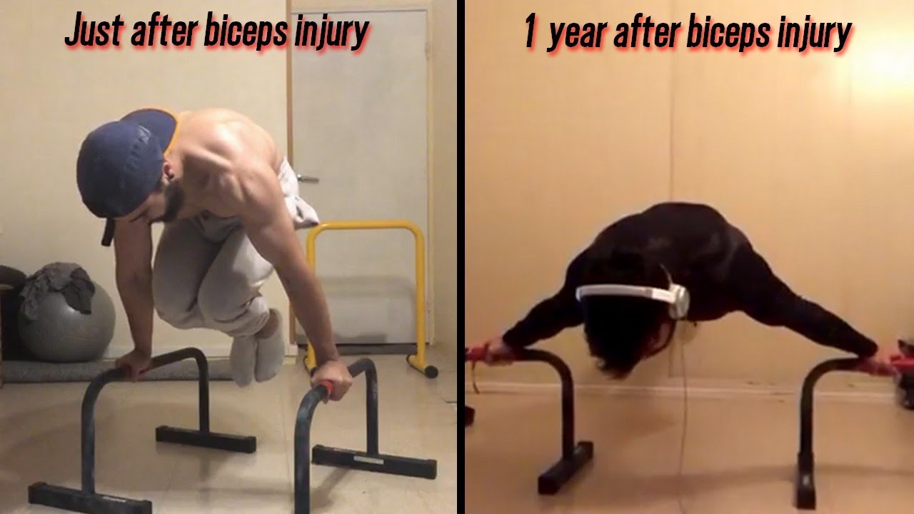 1 YEAR AFTER BICEPS INJURY PROGRESSION - @ONIZUKA_OTZ