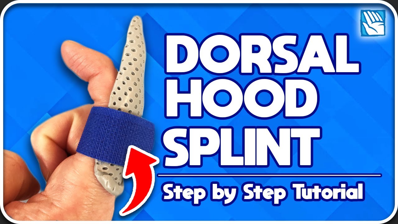 How to Make a Dorsal Hood Splint - Pip Joint Volar Plate Injury