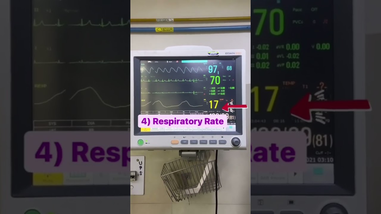 Basic to reading a patient's Monitor 🎞️ (ICCU)