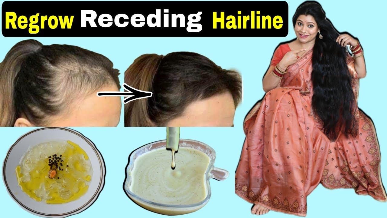 Regrow Receding Hairline : 2 Most Powerful Remedies To Regrow New Hair, Hairline &To Get Thick Hair