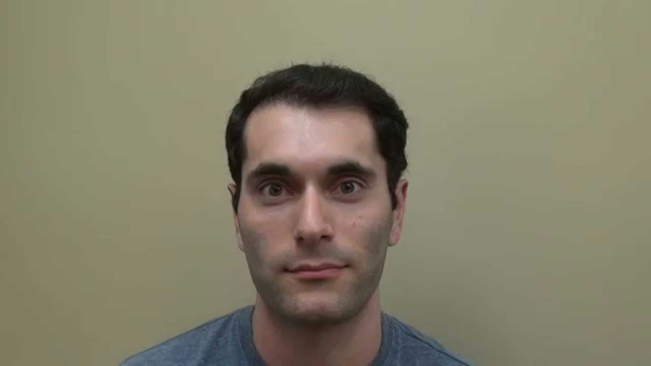 Hair Transplant Before and After Result Frontal Balding Dr. Diep San Francisco www.mhtaclinic.com
