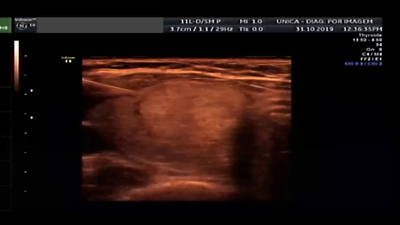 PUN&Ccedil;&Atilde;O OU PAFF DE TIREOIDE