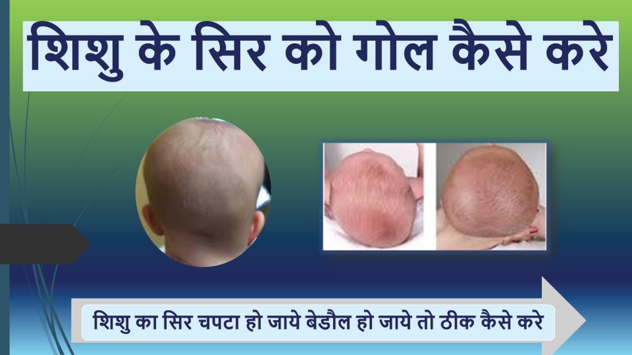 शिशु के सिर को गोल कैसे करे | शिशु  का सिर चपटा हो जाये बेडौल हो जाये तो ठीक कैसे करे