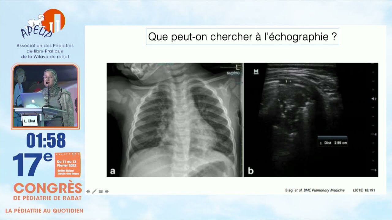 APELIP 2022  Échographie thoracique en pédiatrie : Quelles indications ?  Pr  L.Chat