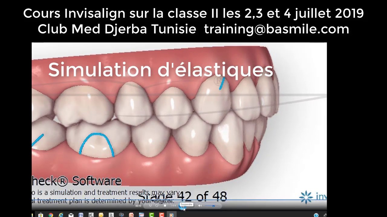Invisalign et classe II : Les 4 solutions Invisalign.