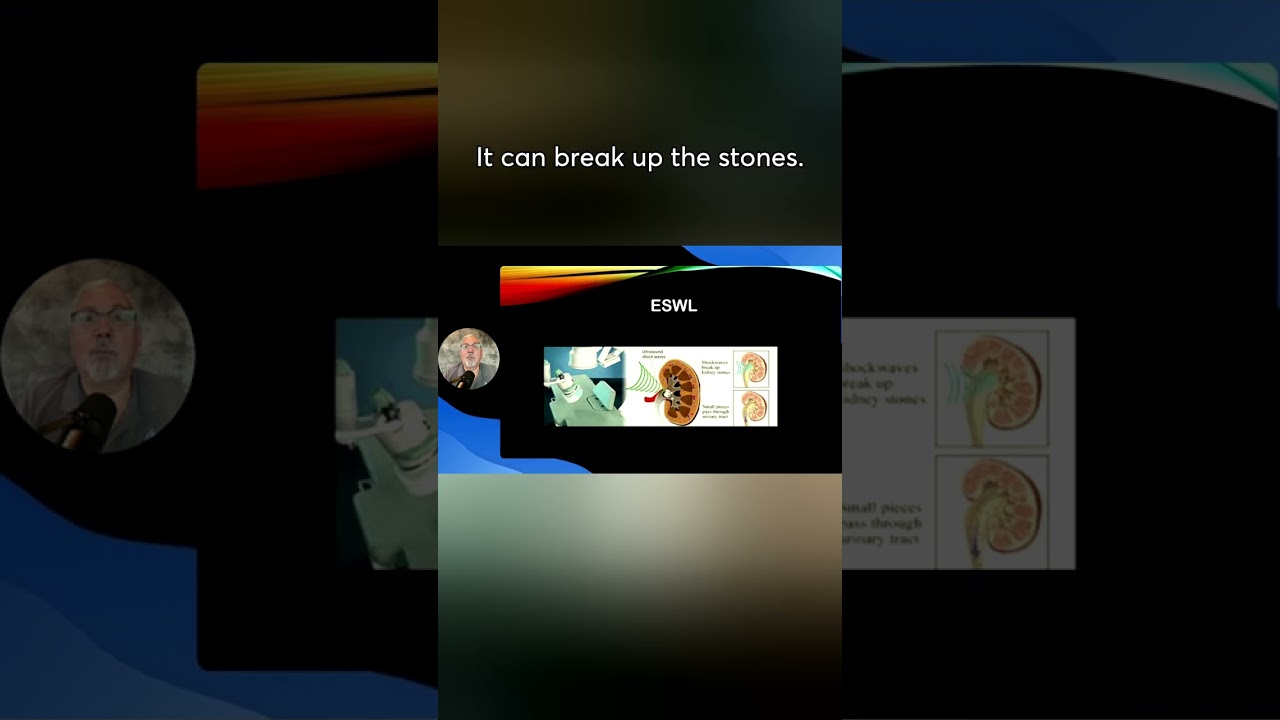Breaking Down ESWL: A Revolutionary Kidney Stone Treatment