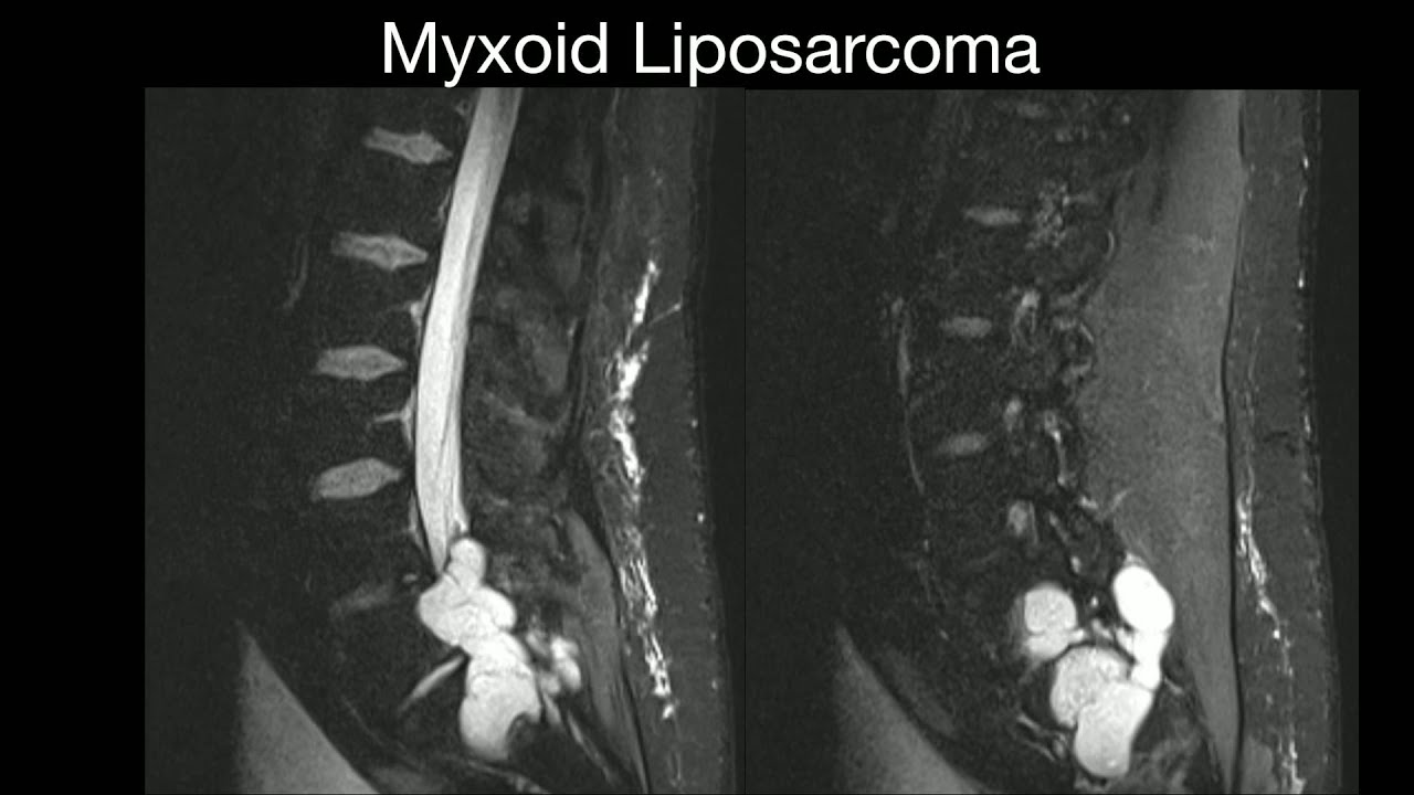 Myxoid Liposarcoma