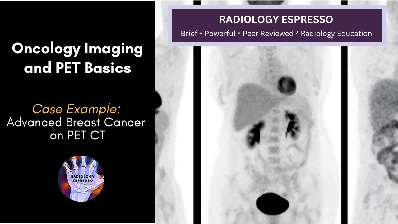 ONCOLOGY IMAGING and PET BASICS: Case Example - Advanced Breast Cancer on PET CT (5450)