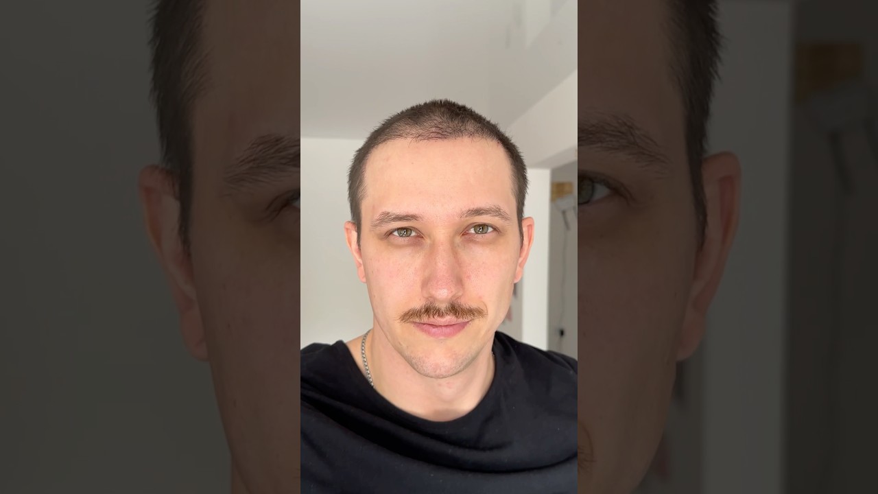 Пересадка волос спустя 6 месяцев! HairHub Clinic