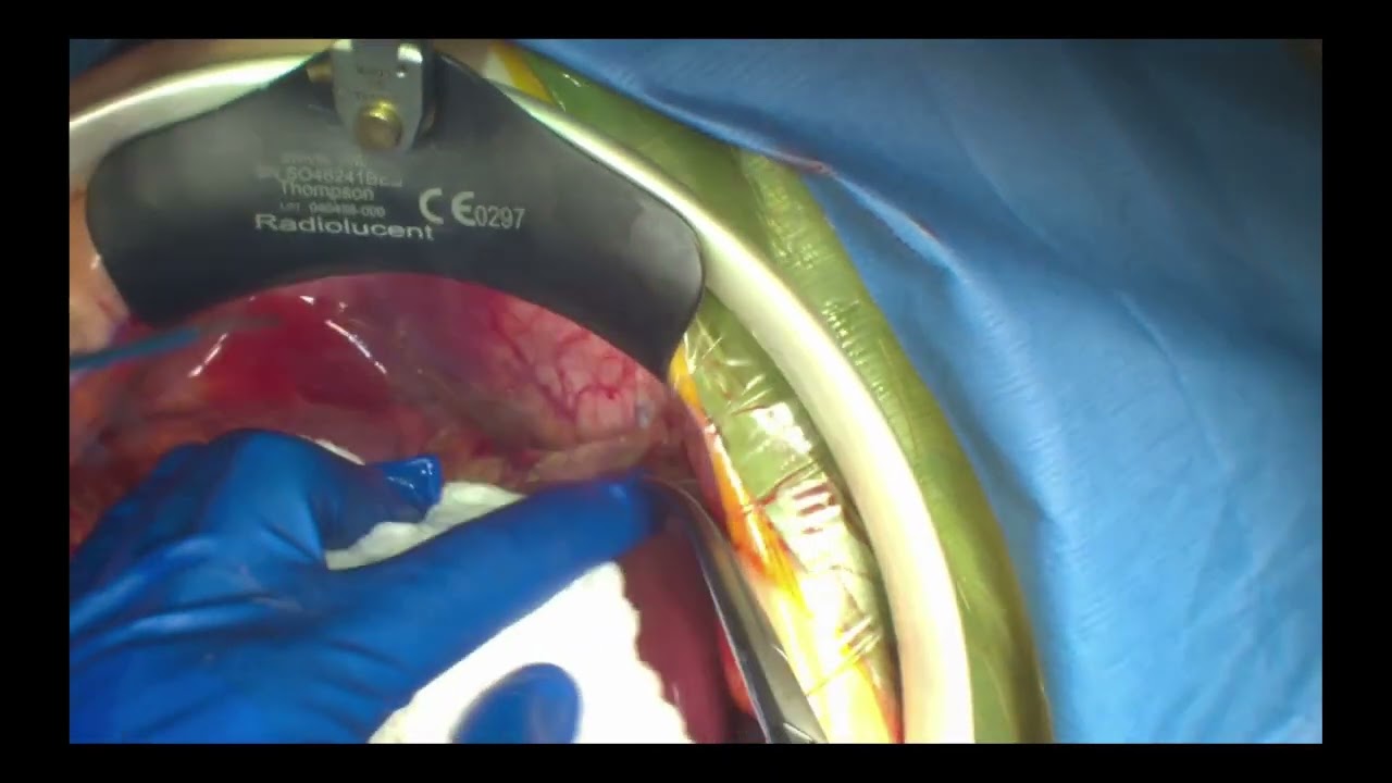 Ex-vivo Liver Resection EXTENDED
