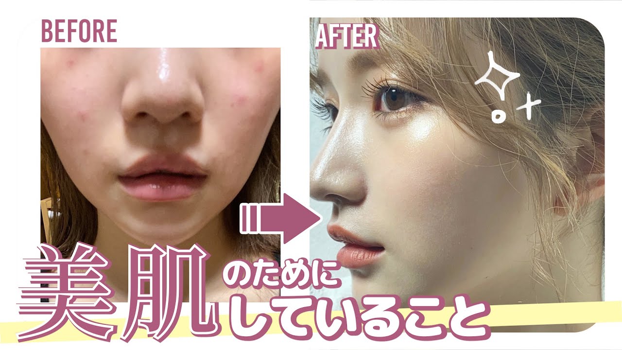 【美肌】ニキビや毛穴を改善！美肌のためにしてること・やめたこと！【スキンケア】
