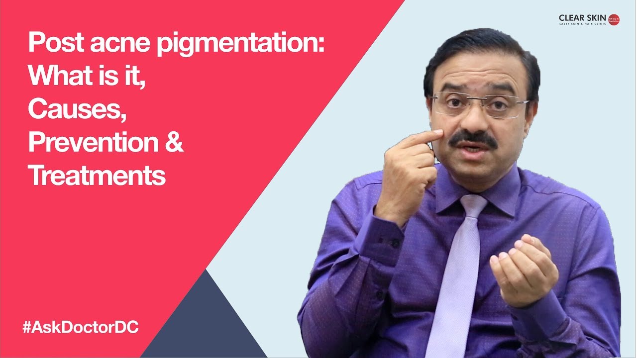 Post acne pigmentation: What is it, Causes, Prevention & Treatments (English)