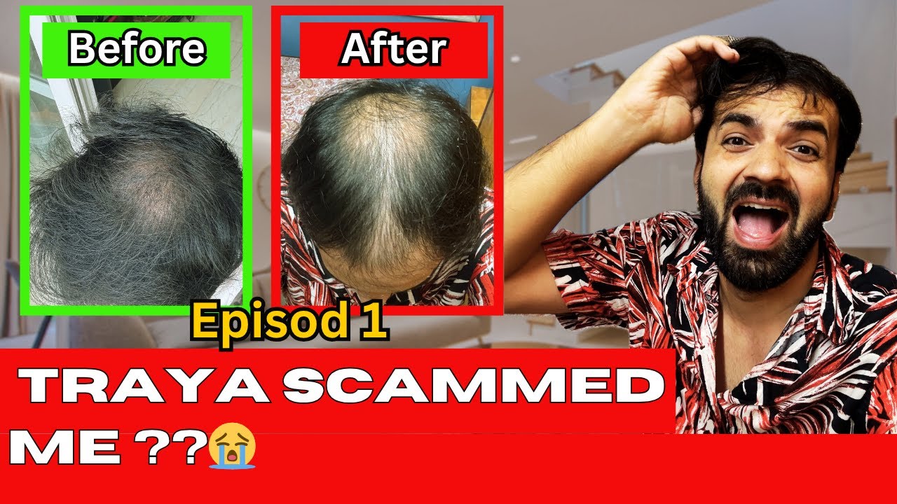 Traya scam on 1 year hair result ? | EP 01- The regrowth project.