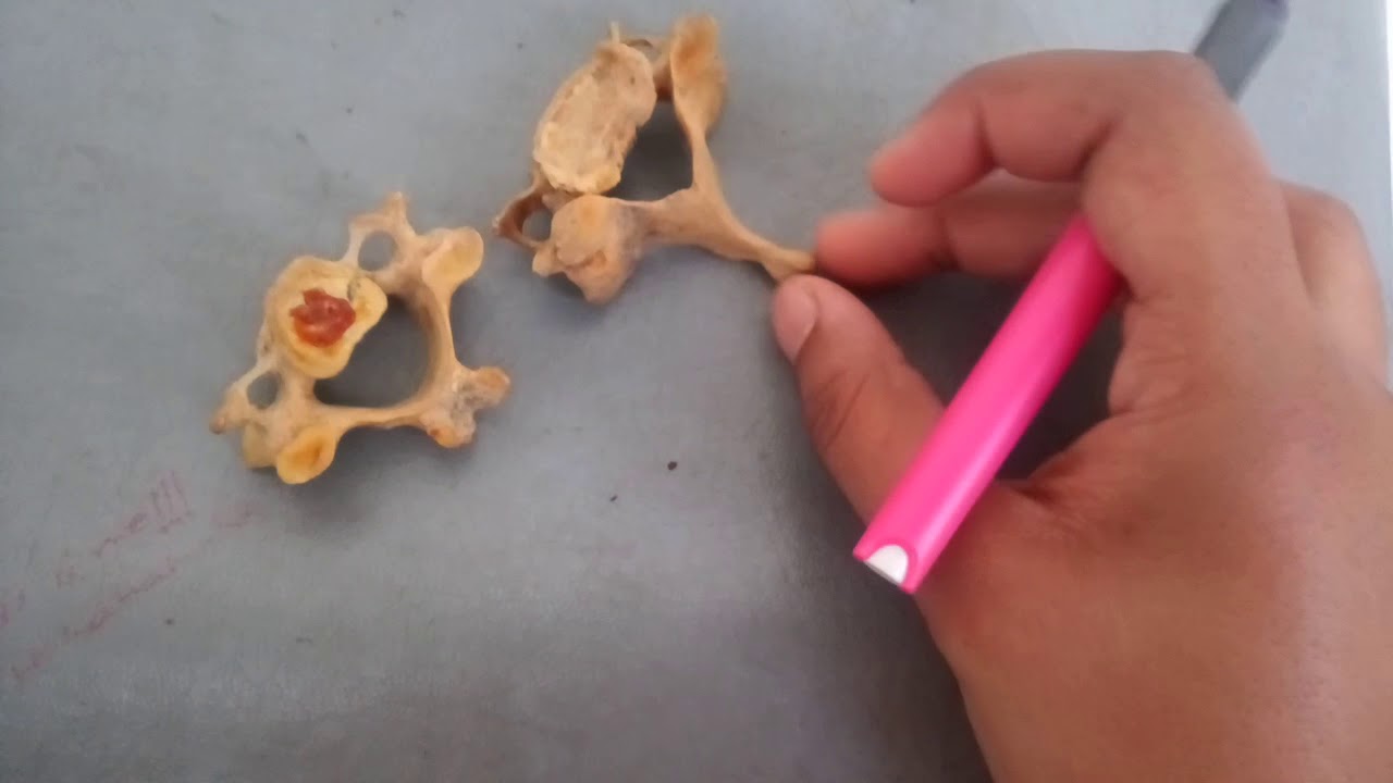 7th CERVICAL VERTEBRA spotting in easy way