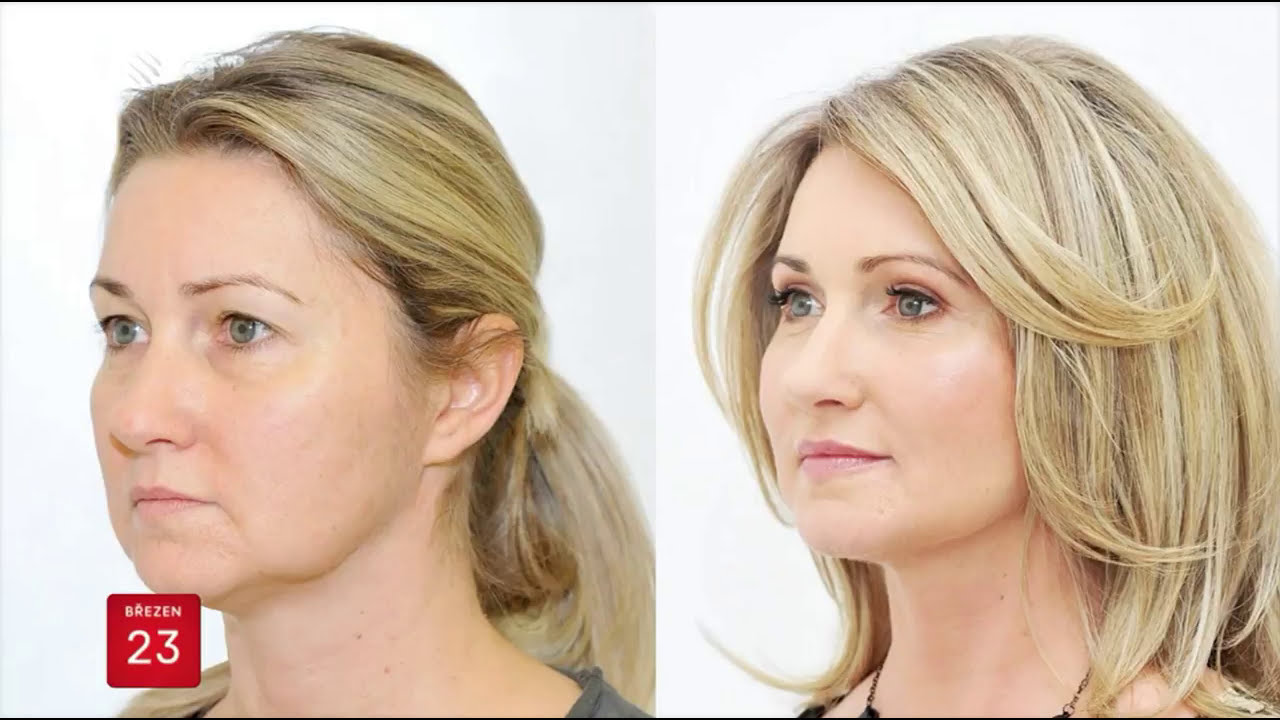 Dermatologie Kliniky YES VISAGE v pořadu Sn&iacute;daně s NOVOU