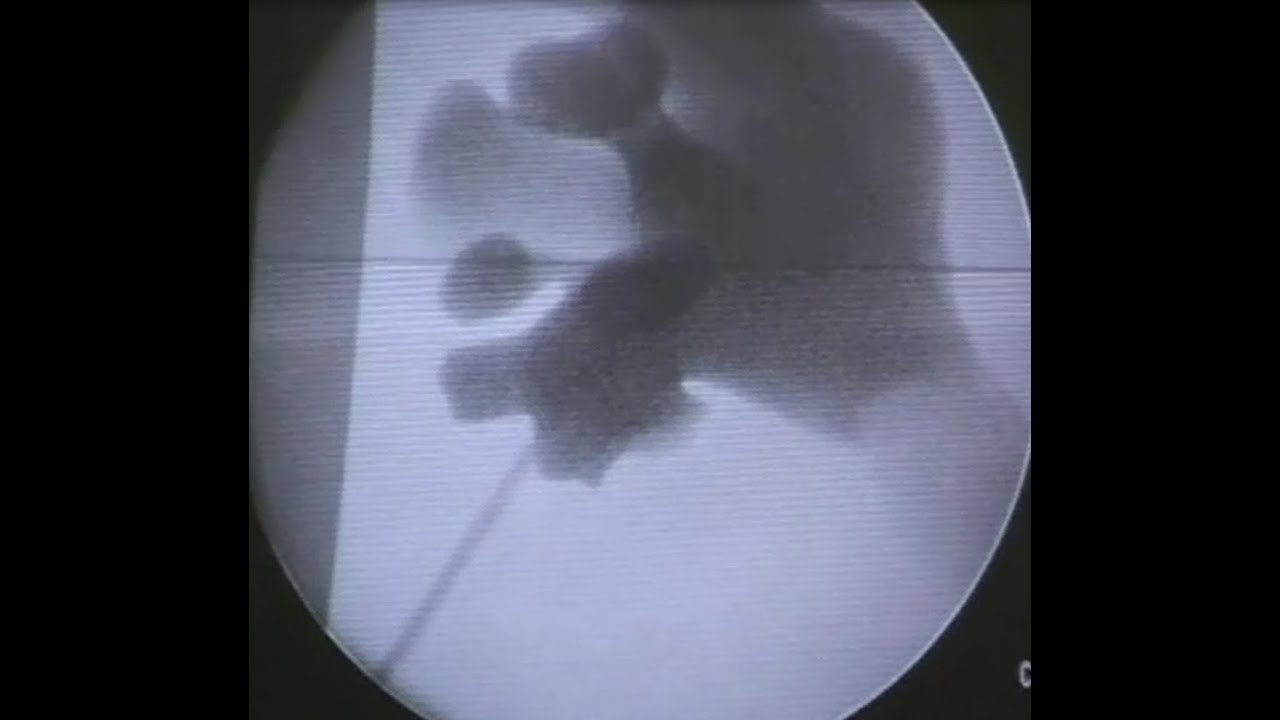 PCNL Access with Fluoroscopy    Monoplanar Two dimesion Technique Movie