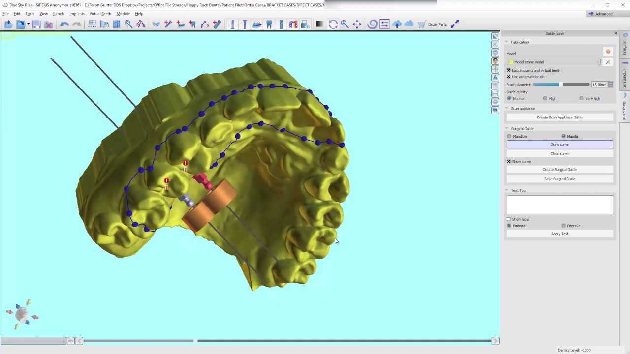 U-Penn Skeletal Expander: Digital Case Planning
