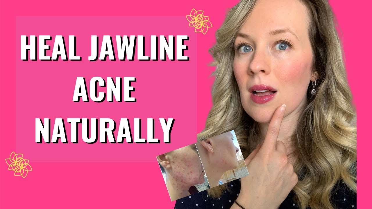 Jawline Acne Treatment-ACNE UNDER JAWLINE NATURAL TREATMENT