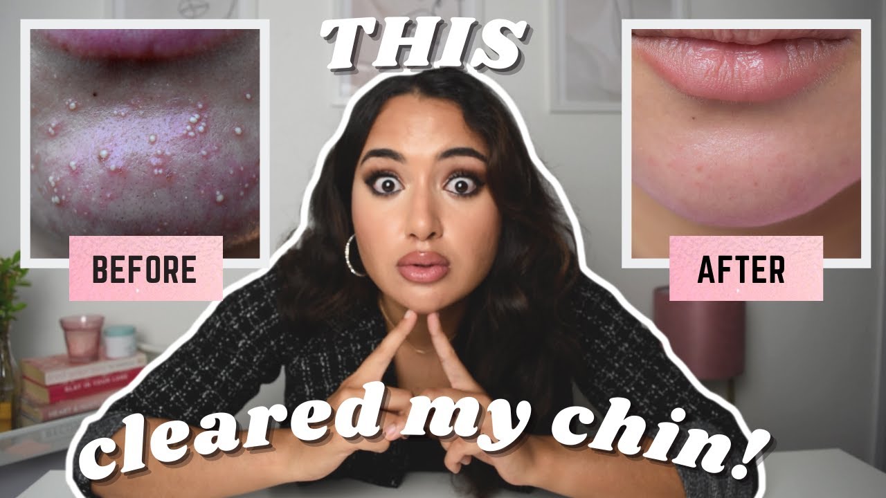 HOW I CLEARED MY SKIN FAST | How to clear chin acne with Clindamycin | Before and after results.