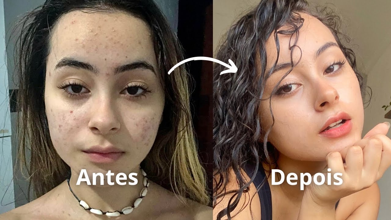 a rotina de skincare que FINALMENTE salvou minha pele | acne e oleosidade 