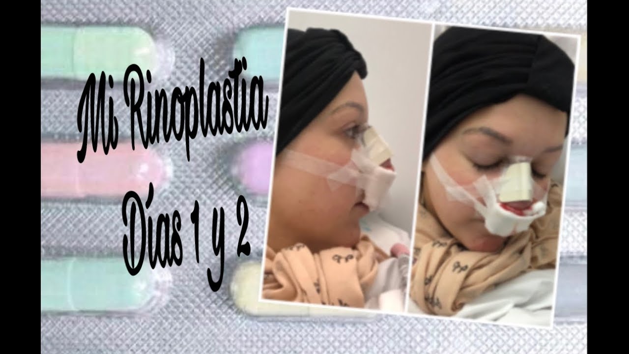 MI RINOPLASTIA-DÍAS 1 Y 2 +CONSEJOS- DORSIA