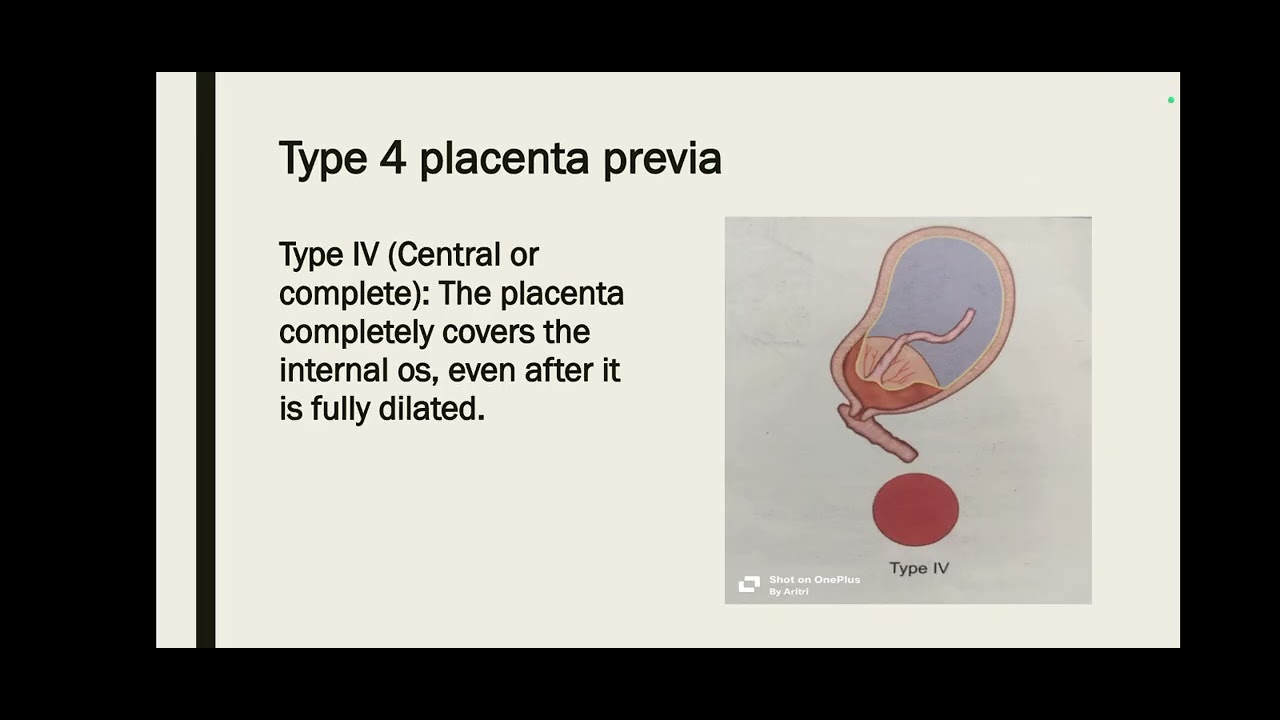 Placenta previa 