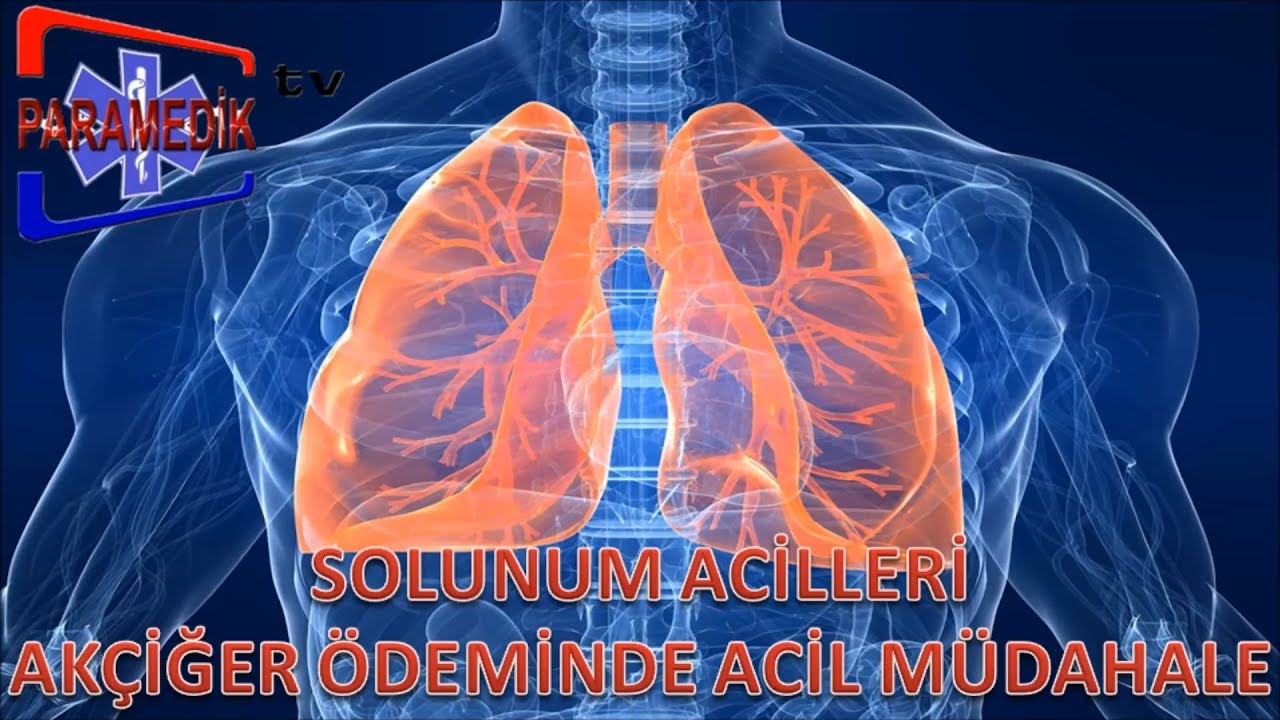 SOLUNUM ACİLLERİ - Akut Akciğer Ödemi'ne Nasıl Müdehale Edilir ?