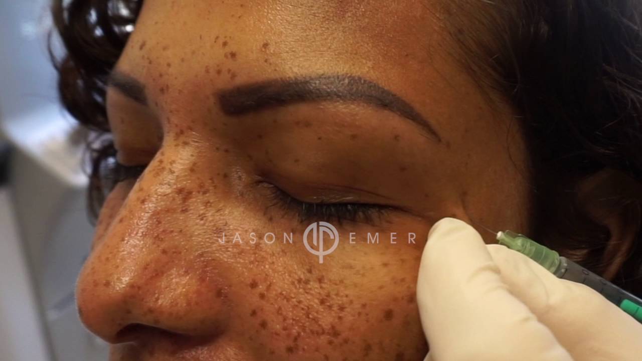 Get Rid of Crows Feet, Wrinkles And Fine Lines | Allergan Botox Injection for Anti-Aging Prevention
