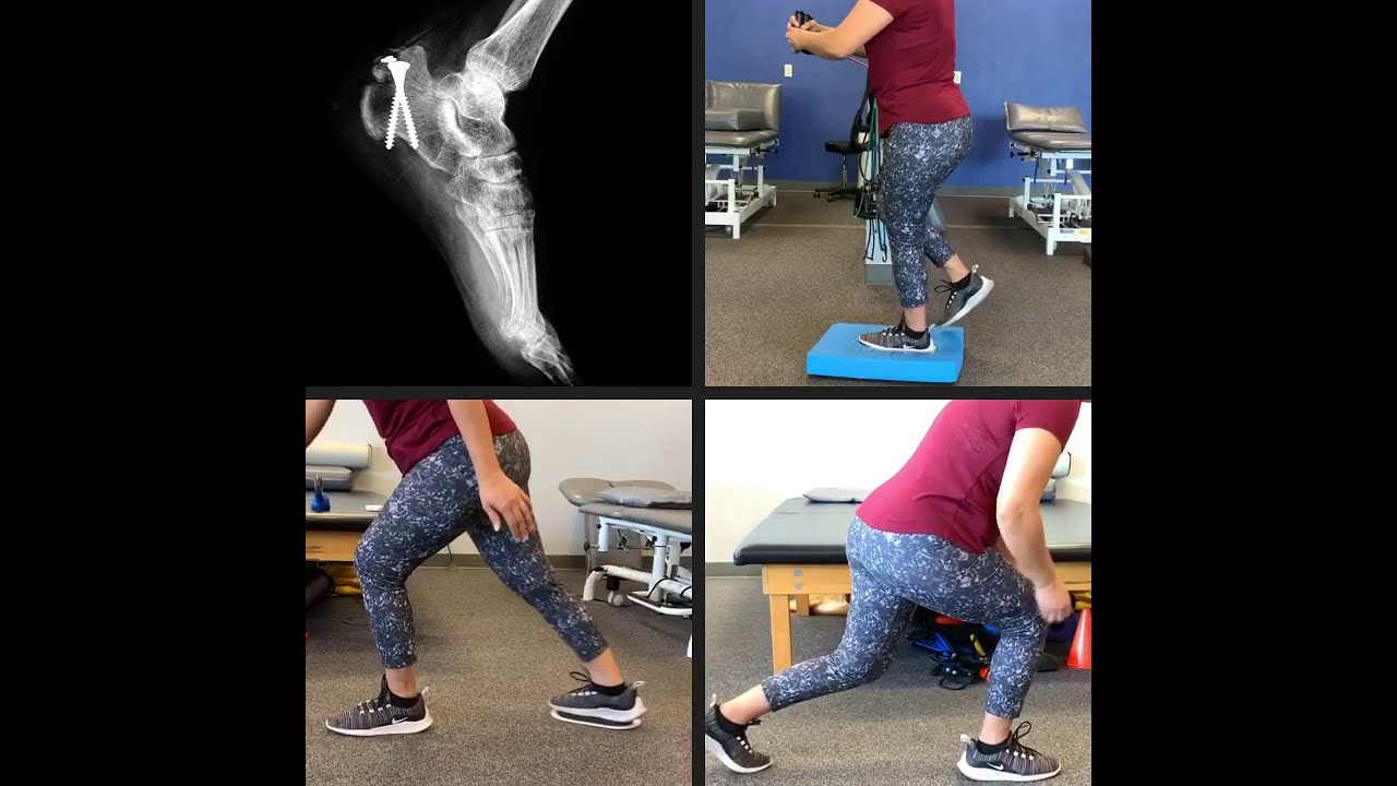Calcaneal Fracture Exercises (Real Patient
